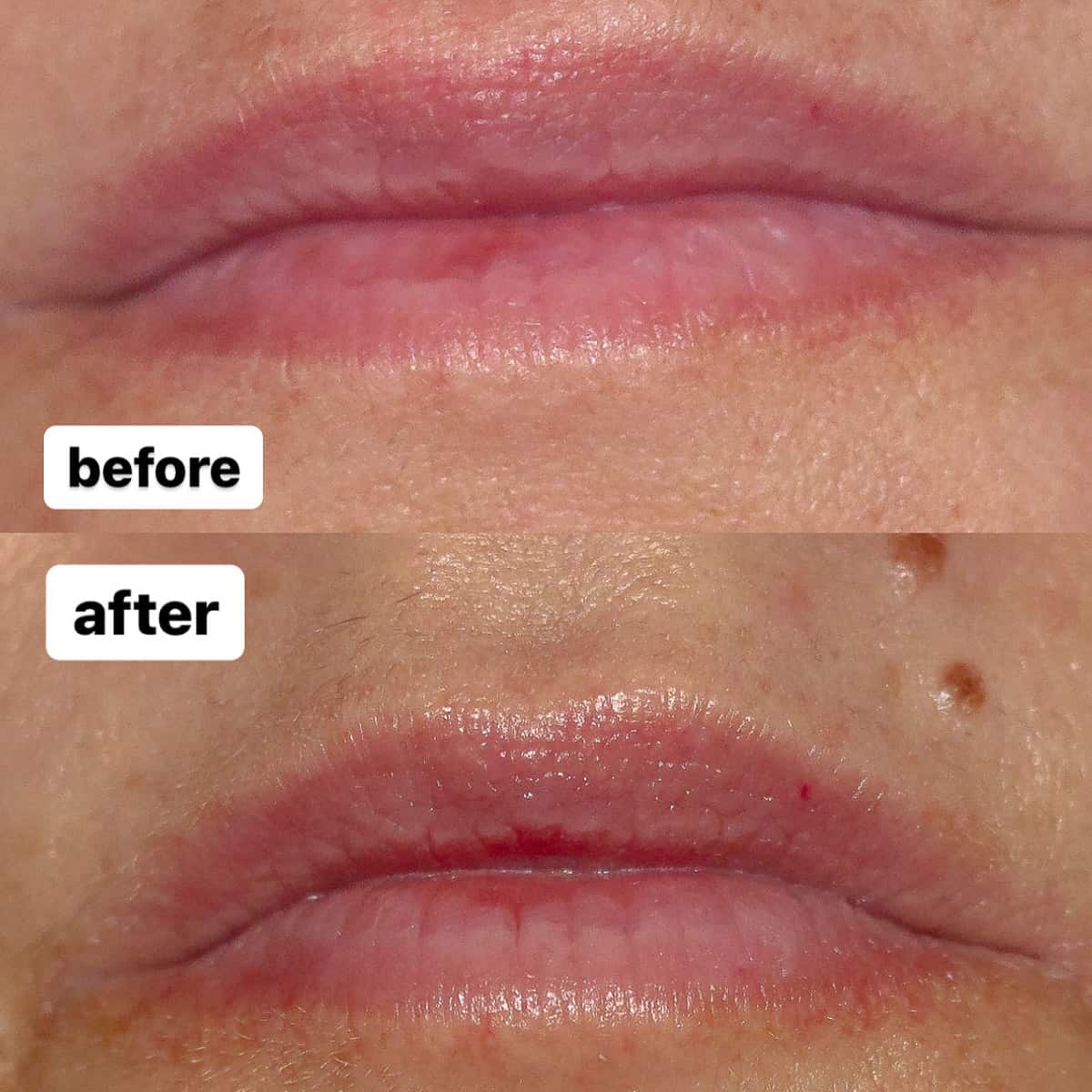 Before and after of my lips after using Neostrata Targeted Lip Filler for 1 week