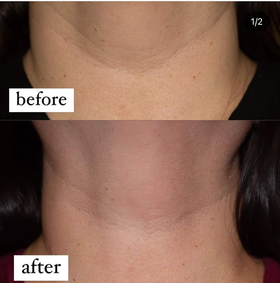 before and after pictures of my neck