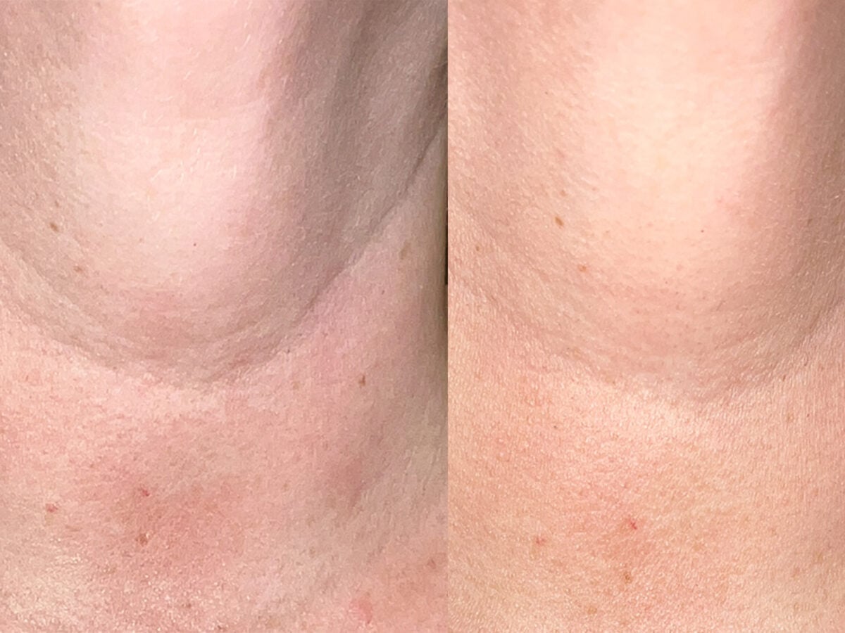 Close up of before and after neck.